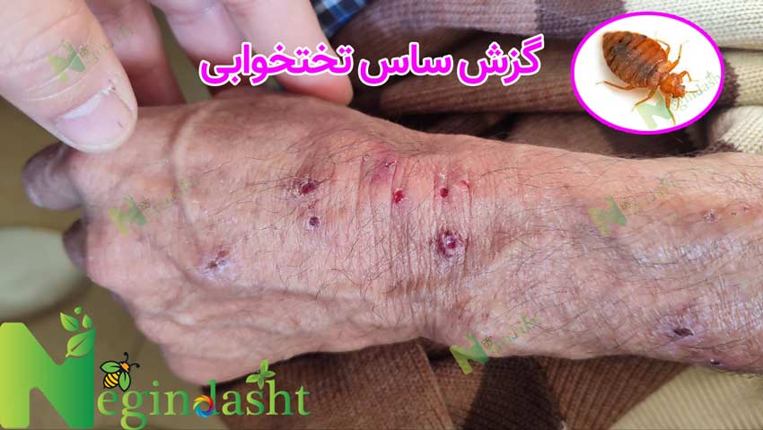 Bedbug bite negindasht did34